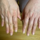 바른병원 맞은편 | 버스에서 넘어지면서 어깨탈구, 상완골 골절, 관절와순 파열 - 삼성바른병원 입원 후기