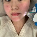 해아림한의원부산센텀점 | [부산센텀]얼굴패인흉터, 모공흉터 새살침 후기 + 포텐자 1회차 피부과 내돈내산 후기