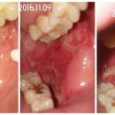 구강내 염증(혐오사진 주의)문의 ㅜㅜ 고통스럽네요 이미지