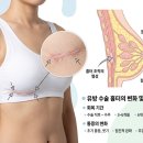 가슴수술흉터 치료 언제 옅어질까 회복기간 통증 변화는?