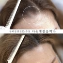 마음에점을찍다두피SMP 이미지