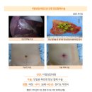 다발성담석증수술후기. 수술 전 당일진료, 당일 수술 예약을 통해 빠르게 수술 진행할 수 있었던 것도 큰 매력이었고... 이미지