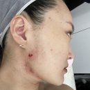 ATS화장품 | 회복기간7주차 홈케어루틴 전주여드름재생크림추천 물방울필링케어 ats샷 여드름재생후기 익산문제성피부
