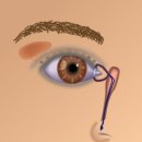 양재욱 | [투병기4] 성인 눈물길 막힘+ 눈물길 전문의 정보공유