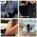 든든한의원 | 비만클리닉의원 하프한 옆구리 팔뚝 지방분해주사 2회차 효과 후기