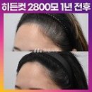 헤어라인 이미지