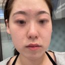 잡티, 주근깨 레이저 루비레이저 찐내돈내산 압구정 엄청 유명한 그 피부과 방문해서 663방 맞고 온 후기