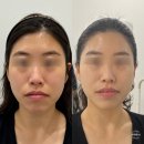 콜드플라즈마 공식지사 아미뷰티 아카데미 | 대구 신부관리로 작은얼굴 만들기! 페이스리프팅::콜드플라즈마지사 아미뷰티 아카데미 후기