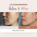 풀페이스의원 | 풀페이스지방이식후기 중안부 축소 2개월 효과