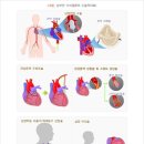 허혈성심장질환 분류표와 2대 심장질환 분류표의 비교 이미지