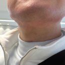 플러스의원 | 벤스의원 수지 젠틀맥스프로플러스 남성 제모 가격 1년 무제한 후기