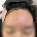 양지-2855 | 군산 나운동 [무이] , 페이스왁싱 (헤어라인 왁싱) 받은 후기