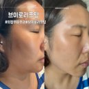 브이 | 의정부피부과 가성비 울써마지 안아픈 브이로리프팅 솔직후기