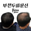 온헬스케어주식회사 | 부천두피문신 삭발만 답이 아니다 자연스러운 탈모달인의 기술
