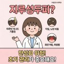런드렛아쿠아워시신림 | 지루성 두피염, 샴푸만 바꿔도 좋아질까? 관리 핵심 정리
