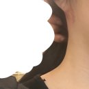 땡큐독 | 이하선종양 수술후기 (2)