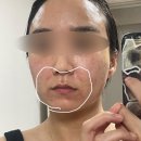 톤즈의원 하남미사점 | [피부관리/내 돈 내산/혐주의] 톤즈의원_하남미사점(리쥬란)