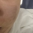 고은 에스테틱 | 강동구 좁쌀 트러블관리 고은결에스테틱 압출 후기