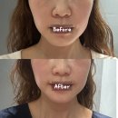 한국지엠논현서비스 | 신논현역피부과 온다리프팅 6만줄 일주일 후 솔직 후기