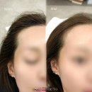 유뷰티 - 청도군 고수서4길 12-2 | 목동 헤어라인 전문 추천 M자 고민 해결한 더유뷰티 후기