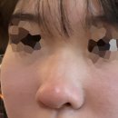 진**-1 | 복코 무보형물 비개방코수술로 얄쌍해진 1개월차 후기 (전후 사진 포함)