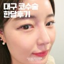 한장한코 | 대구 성형외과 코수술 한달 경과 솔직후기