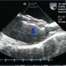 심장 초음파[echocardiography] 이미지