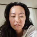 나원섭치과 의원 | [모아만의원] 선택 이유와 헤어라인 3000모 모발 이식(절개)내돈내산 후기-1차