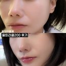 강남-200 | 강남 울트라콜 200, 피부과 가격과 후기 추천해요