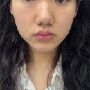 형상과 현상 | 보톡스 전후 효과 시기 후기 (이마 미간 자갈턱 입꼬리 턱 측두근 ) + 부작용 경험담
