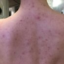 미강 | 등드름 흉터제거 한의원에서 받은 미강약침 후기