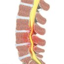 [대구척추병원]척추관이 좁아져서...몸이... 이미지