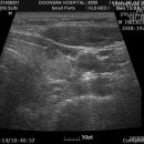 hypoechoic illegullar nodule 이미지