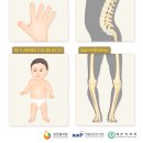 연골 형성저하증 : 질병정보 이미지