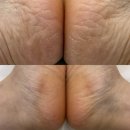 수원-1448 | [수원] 레푸스 수원영통점 : 수원발각질 고민 끝 레푸스 수원영통점 뒤꿈치 각질관리 후기