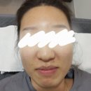 성신한의원 | [돈암동 한의원] 성신여대 근처 규장한의원에서 미주란 시술받은 내돈내산 후기