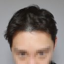 포유헤어1 | 용인SMP 탈모커버 후기 닷포유 SMP 용인분당점 헤어라인 교정 1회 체험 리얼후기