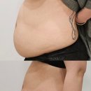 구월동 다이어트 시술 클리닉 제로컷주사 2회차 후기 (위고비처방가능병원)