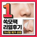 (주)영레이저 | 쏙모팩 내돈내산 효과 후기: 소극성속모증 가시털 제거 레이저 대신 쓴 결과