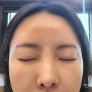 (주)지피코 1공장 | 송파 피부과 눈밑꺼짐 쥬베룩아이 효과 본 내돈내산 후기