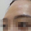 더리터 삼천포점 | [공지] 동탄 필러 리모어가 집중하는 3가지 포인트