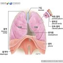 악성중피종 이미지