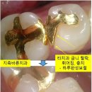 바른교정치과기공소 네이버블로그