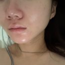 명현 | 극 지성피부 이소티논 한달 복용 후기 | 효과, 부작용, 명현현상, 우울감, 피로감