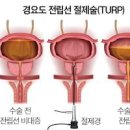 전립선 비대증 약 수술 방법, 좋은음식 (야간 빈뇨 절박뇨 잔뇨감) 이미지