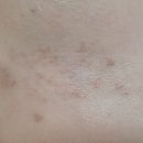 닥터구글마취통증의학과의원 | 30대 대상포진 후기 5주일차. 통증과 흉터를 이겨내는 중