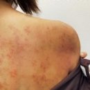 군포한의원 | 군포 습진 한의원 방문하고 옴