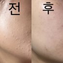 참존회원권 | 문제성 피부 일지+추천템(에스테틱 압출/올리브영 빅세일/스킨케어/세안/내돈내산)