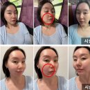 우와우 | 신사역 올타이트리프팅 400샷 착붙 리프팅 후기 / 전후비교/ 통증 / 효과