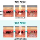글로비지테라안티에이징의원 | 기미 잡티 부수기! 피코 레이저 토닝, 첫 1회 후기